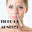 Acne Plan
